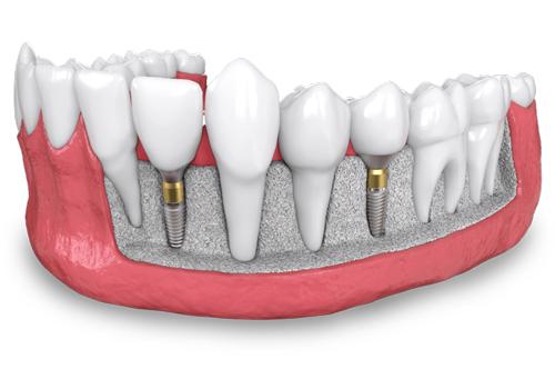 a model showing two, placed dental implants